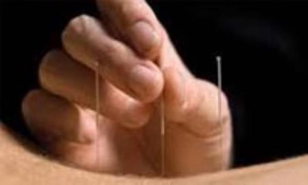 چگونگی درمان در طب سوزنی چگونگی درمان در طب سوزنی