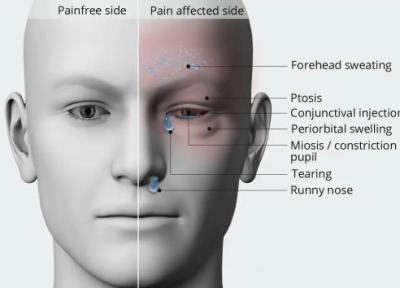 راهنمای کامل و علمی سردرد کلاستر ، نکات ضروری